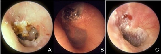 Description cholesteatoma type acquire