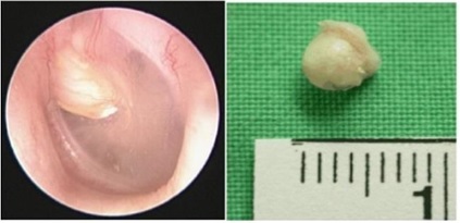 Description cholesteatoma type congenital