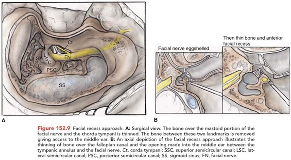 Mastoidektomi dengan facial recess appproach