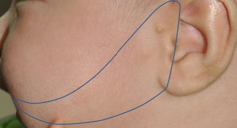 Picture 1 . A A in triangle arch. A A found in triangle mearkus from the groove of the oral commissure to the anterior auricle between the helical spine and the ear lobe. 12