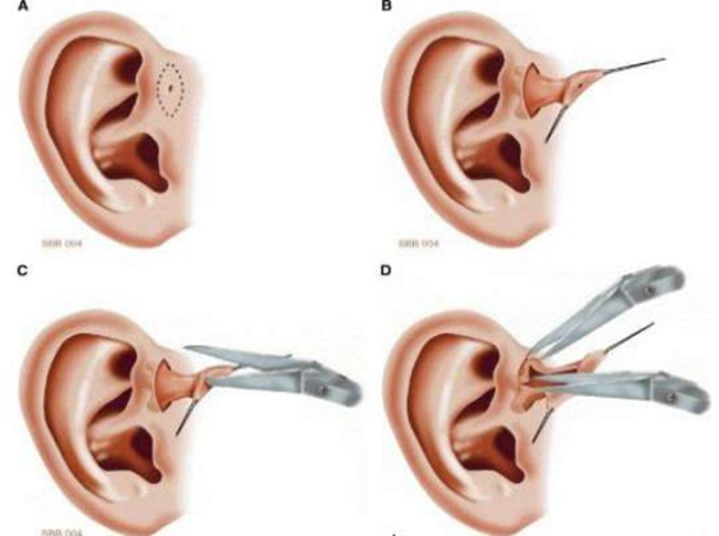 Inside-out technique. 