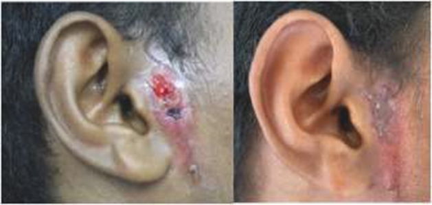 Preoperative photos (a) acute infection;