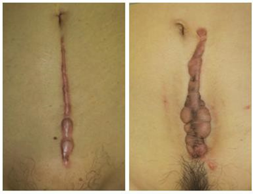 Picture 3. Difference Keloid And Hypertrophic Scars . 13
