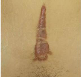 Picture 6. Lesion Intermediate Which Difficult Differentiated. Although difference simple is able to differentiate almost all