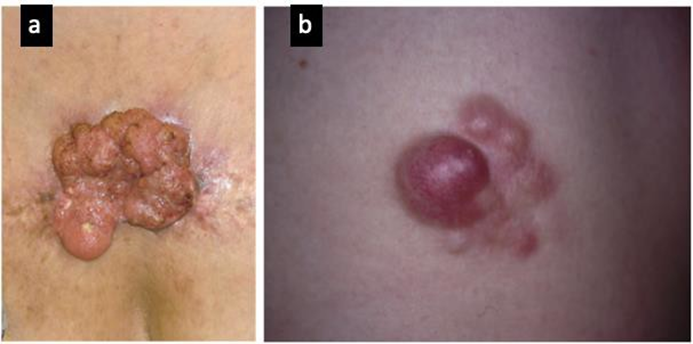 Picture 9. Tumor Malignant Which Similar Keloids. a) Dermatofibrosarcoma protuberans and b) Squamous cell carcinoma. 20