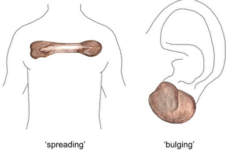 Picture 10. Type Keloid