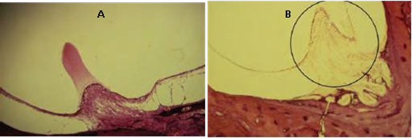 Picture 9 A. Normal Cupula. B. Cupula, cell hair hearing type I And type II disappeared due to gentamicin ototoxicity in the ampulla 40
