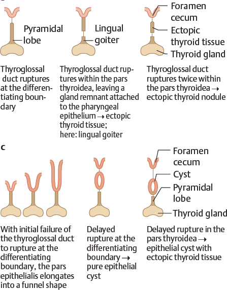 Picture 3A And 3B. Malformation from the glands thyroid. 6