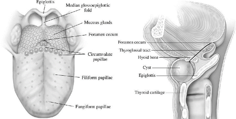 Picture 4. Decrease ductal cyst thyroglossus. 16