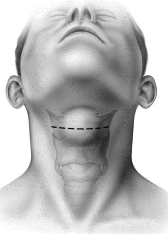 Picture 5. Incision skin in a way horizontal on cyst. 16