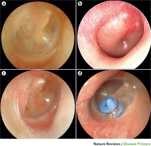 Figure 7. Condition Tympanic Membrane . (a) normal MT; (b) hyperemic and prominent MT. indicates OMA; (c) otitis media with effusion ; (d) MT installed tube tympanostomy 11 .