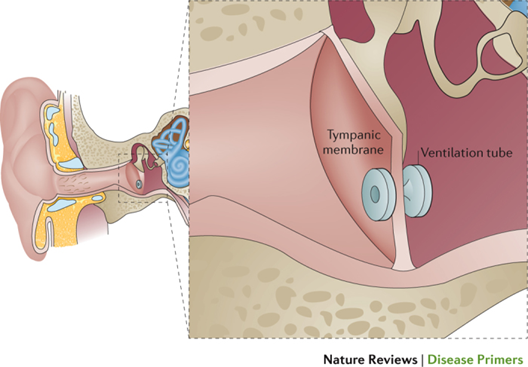 Figure 8. Installation Tube Tympanostomy at MT 10 .