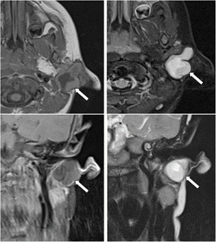 Figure 2.2 MR imaging of a child with purulent ear discharge. Post-contrast T1 axial And coronal (picture hand left) with Axial and coronal STIR images (right hand image) show a thick-walled sinus tract (white arrow) extending into the clinically apparent opening in the left external auditory canal. The tract was surgically excised and was confirmed to represent a first branchial cleft anomaly