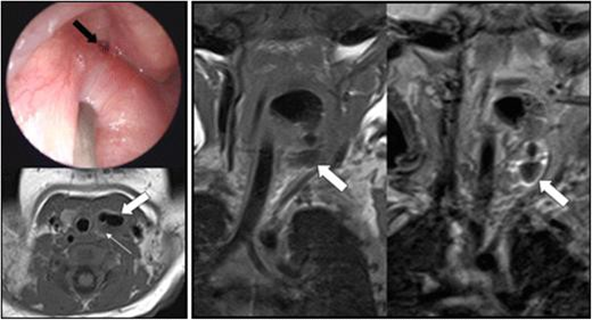 Figure 2.4 This 18-day-old infant presented with intermittent stridor. On examination, left-sided oropharyngeal swelling was identified. Microlaryngobronchoscopy identify opening internal Which arise from the apex of the pyriform sinus (black arrow). Axial and coronal T1 with coronal STIR imaging identified a possible air-containing structure (thick white arrow) extending from the pyriform sinus to the level of the abnormally small left thyroid gland (thin white arrow). This was confirmed surgically by the presence of the fourth branchial cleft sinus tract.