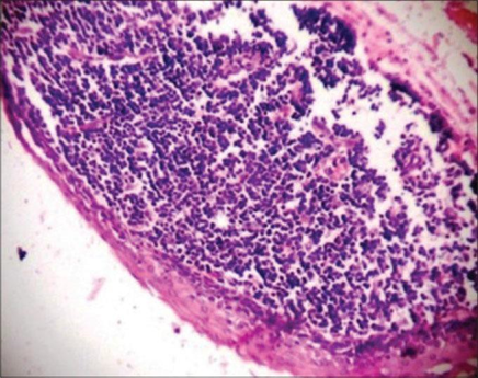 Picture 2.5 A patient woman aged 50 year come to RS with complaint of swelling in the lower jaw since 4-5 months. Photomicrograph shows cystic lumen lined by thin stratified squamous epithelium with flat rete ridges and underlying connective tissue showing abundant lymphoid tissue aggregates (H&E stain, ×100). 7