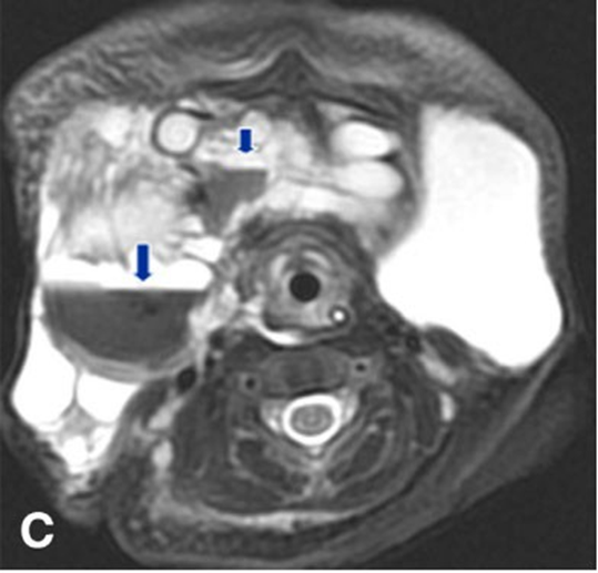 Picture 9. MRI cyst hygroma. 3