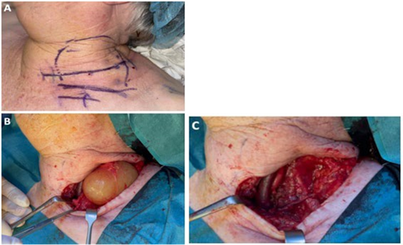 Picture 11. Surgery cyst with incision cervical transversal. 18