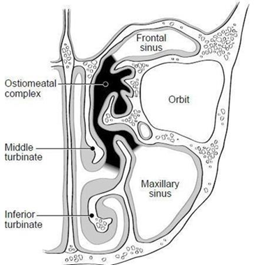 Picture 3. Complex osteomeatal piece Coronal 25