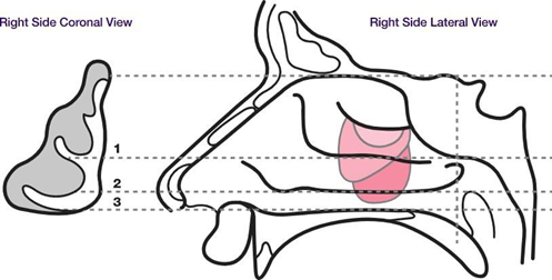 Picture 3. Polyp stage according to Mac Kay and Lund 11