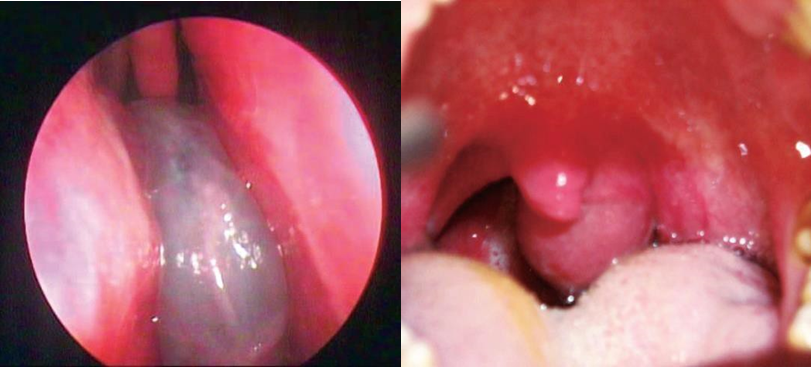 Picture 4. A. Nasoendoscopy polyp antrochoanal. 3 B. Looks polyp antrochoanal behind uvula. 3