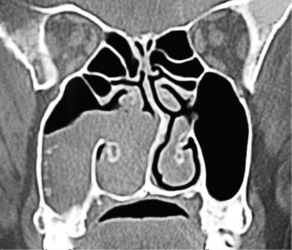 Picture . 5. A. Picture piece coronal CT scan polyp antrochoanal right 3