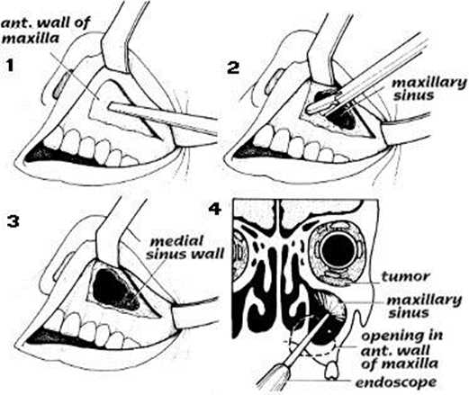 Picture 6. Procedure Luc-Caldwell. 2