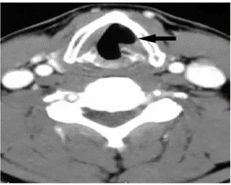 Picture 9. Description CT scan contrast, piece axial, description atrophy flaccid on left vocal fold. Vocal fold in paramedian position 16