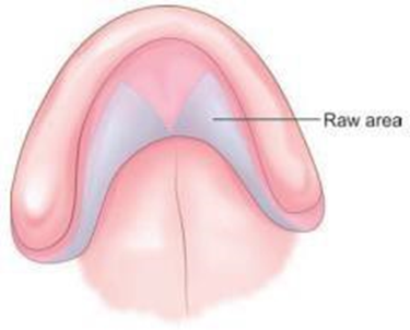 Picture 8 On end operation will there is raw area on lateral side 1