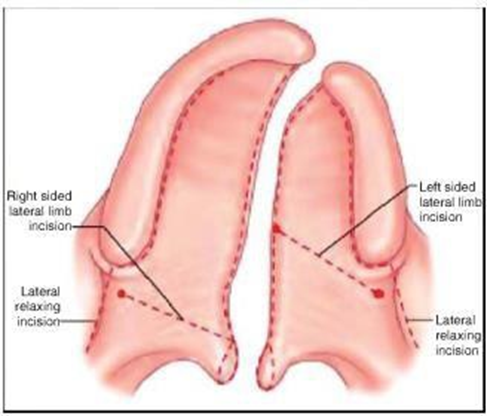 Picture 11 Incision on Furlow palatoplasty 2