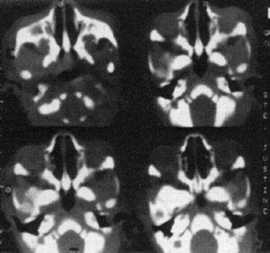 Picture 5. CT scan Show Atresia Koana Type Membrane And Bones. 2