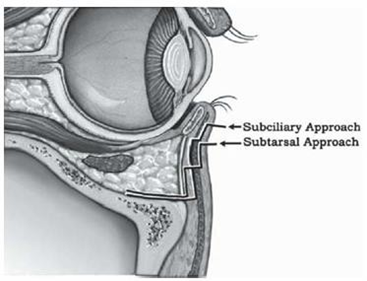Approach Subciliary And Subtarsal