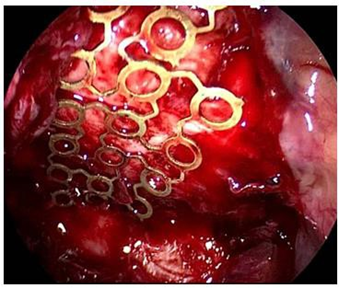 Reconstruction Orbital Floor Fractures with Approach Transantral and Prelacrimal Endoscopy