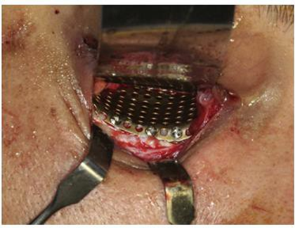 Implants titanium mesh