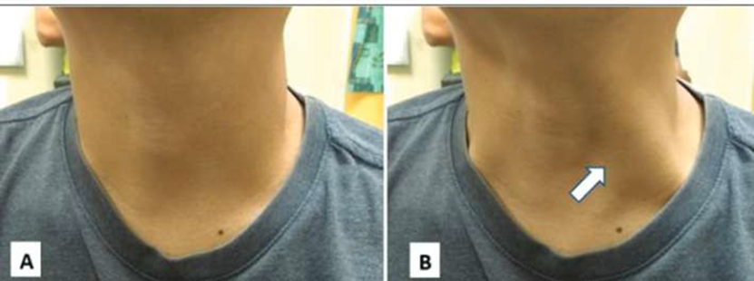 Picture 2.11 Veins jugular internal (arrow) A) moment Rest And B) enlarged during the Valsalva maneuver. 16