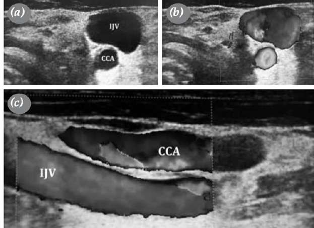 icture&nbsp;USG&nbsp;show&nbsp;phlebectasis&nbsp;vein&nbsp;jugular&nbsp;internal